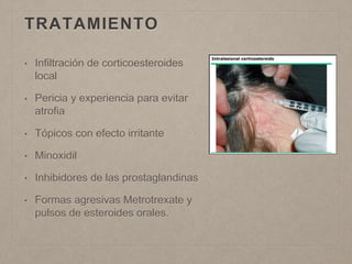 TRATAMIENTO 
• Infiltración de corticoesteroides 
local 
• Pericia y experiencia para evitar 
atrofia 
• Tópicos con efecto irritante 
• Minoxidil 
• Inhibidores de las prostaglandinas 
• Formas agresivas Metrotrexate y 
pulsos de esteroides orales. 
 
