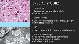 SPECIAL STUDIES
• Laboratory:
• Detection of abnormal protein by
electrophoresis
• Special stains:
• Liver cytoplasmic inclusions are PAS positive
and Diastase resistant
• IHC:
• Liver cytoplasmic inclusions are AAT positive
• Electron microscopy:
• Hepatocytes shows granular material
“misfolded protein” in dilated
endoplasmic reticulum
 