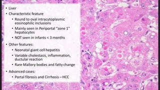 • Liver
• Characteristic feature
• Round to oval intracytoplasmic
eosinophilic inclusions
• Mainly seen in Periportal “zone 1”
hepatocytes
• NOT seen in infants < 3 months
• Other features:
• Neonatal giant cell hepatitis
• Variable cholestasis, inflammation,
ductular reaction
• Rare Mallory bodies and fatty change
• Advanced cases:
• Portal fibrosis and Cirrhosis – HCC
 
