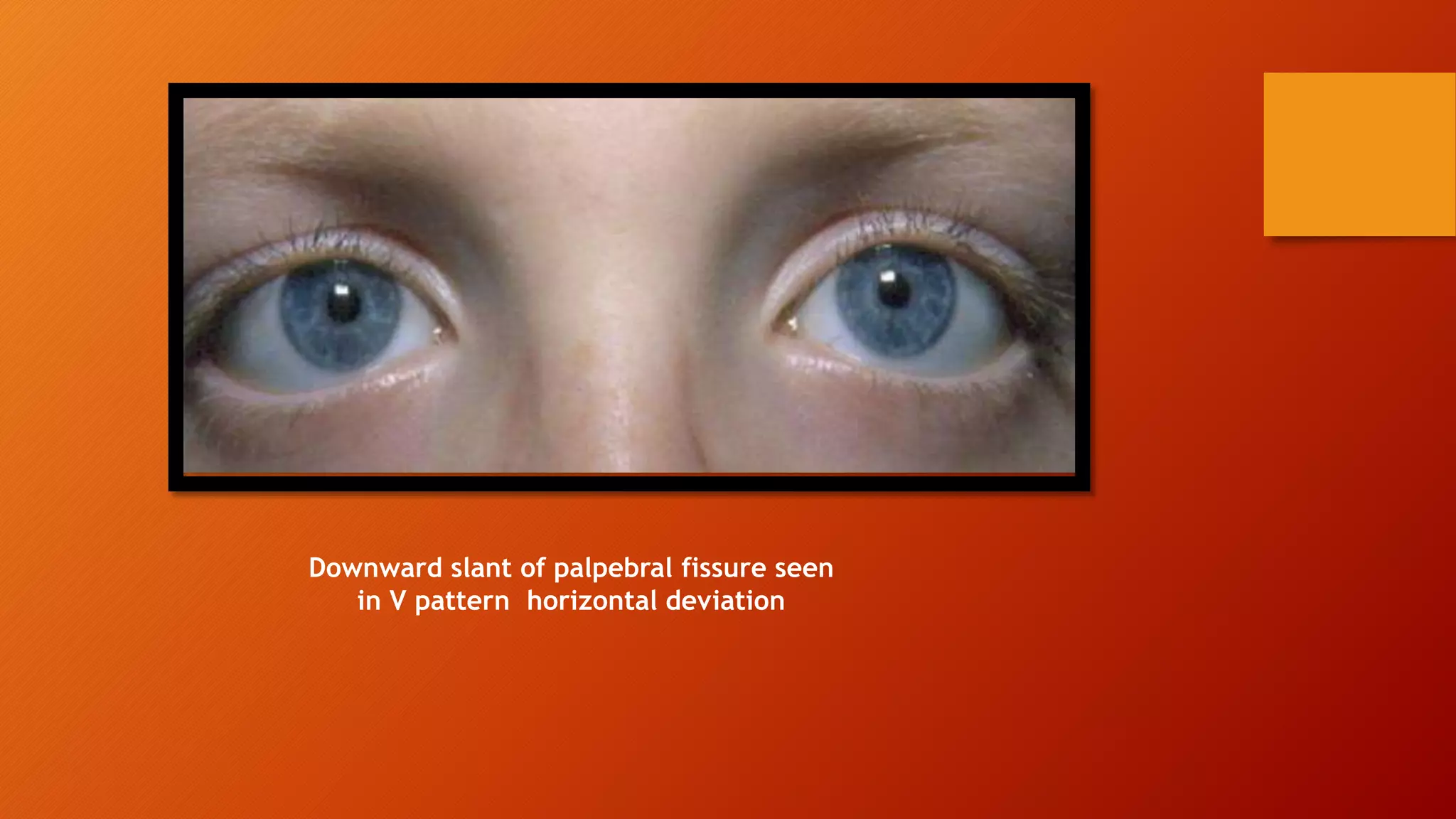 Downward slant of palpebral fissure seen
in V pattern horizontal deviation
 