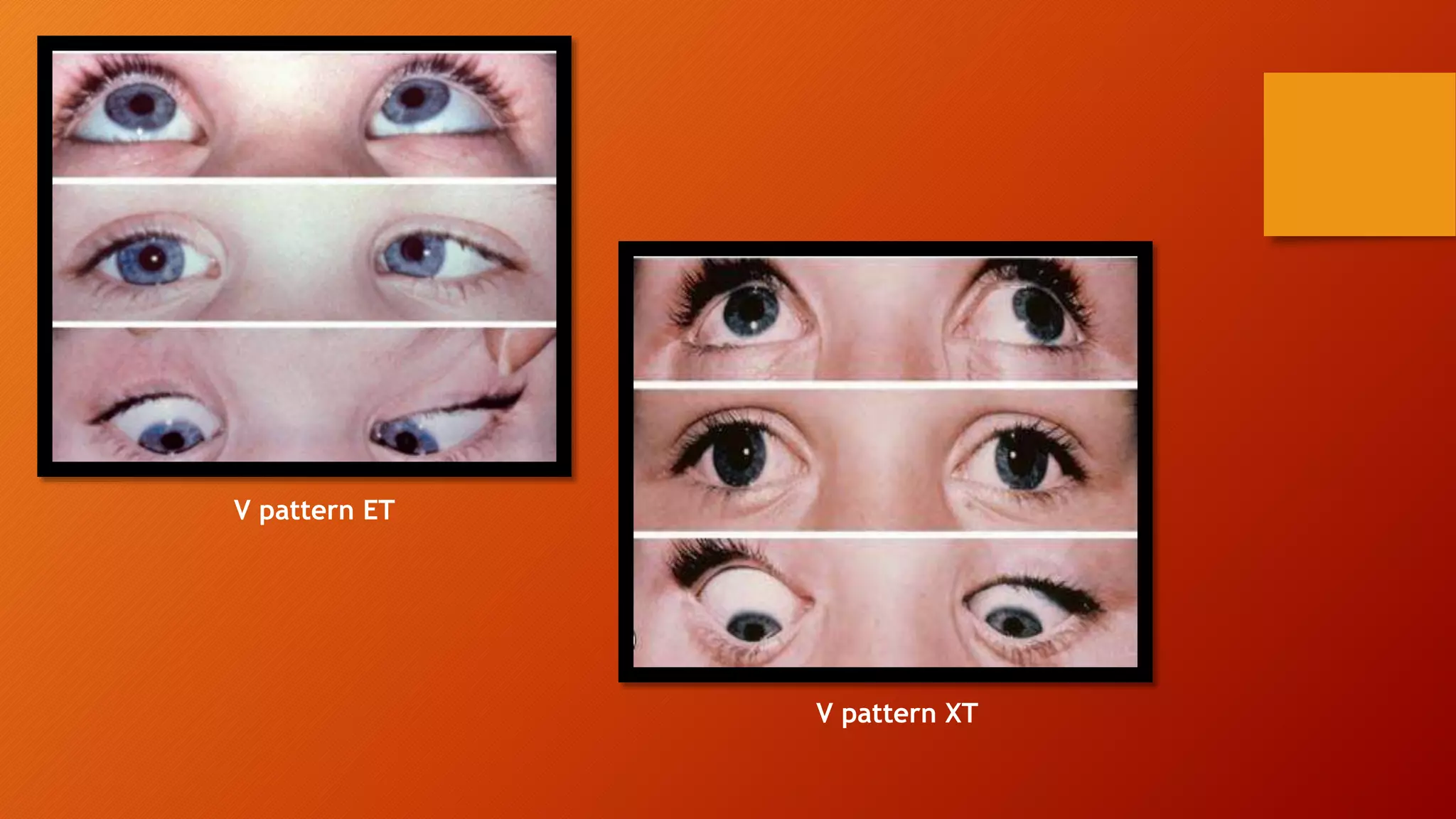V pattern ET
V pattern XT
 
