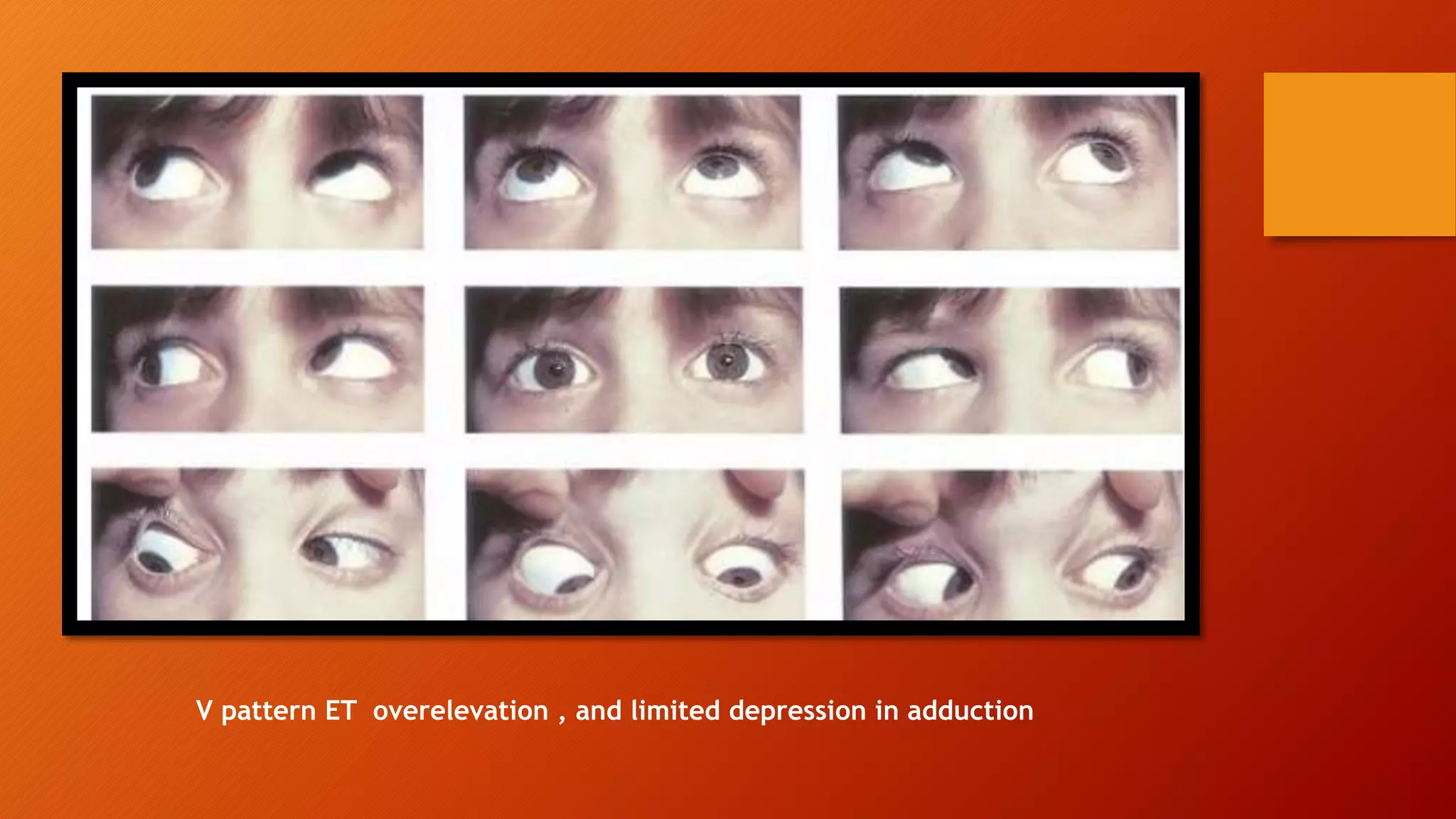 V pattern ET overelevation , and limited depression in adduction
 