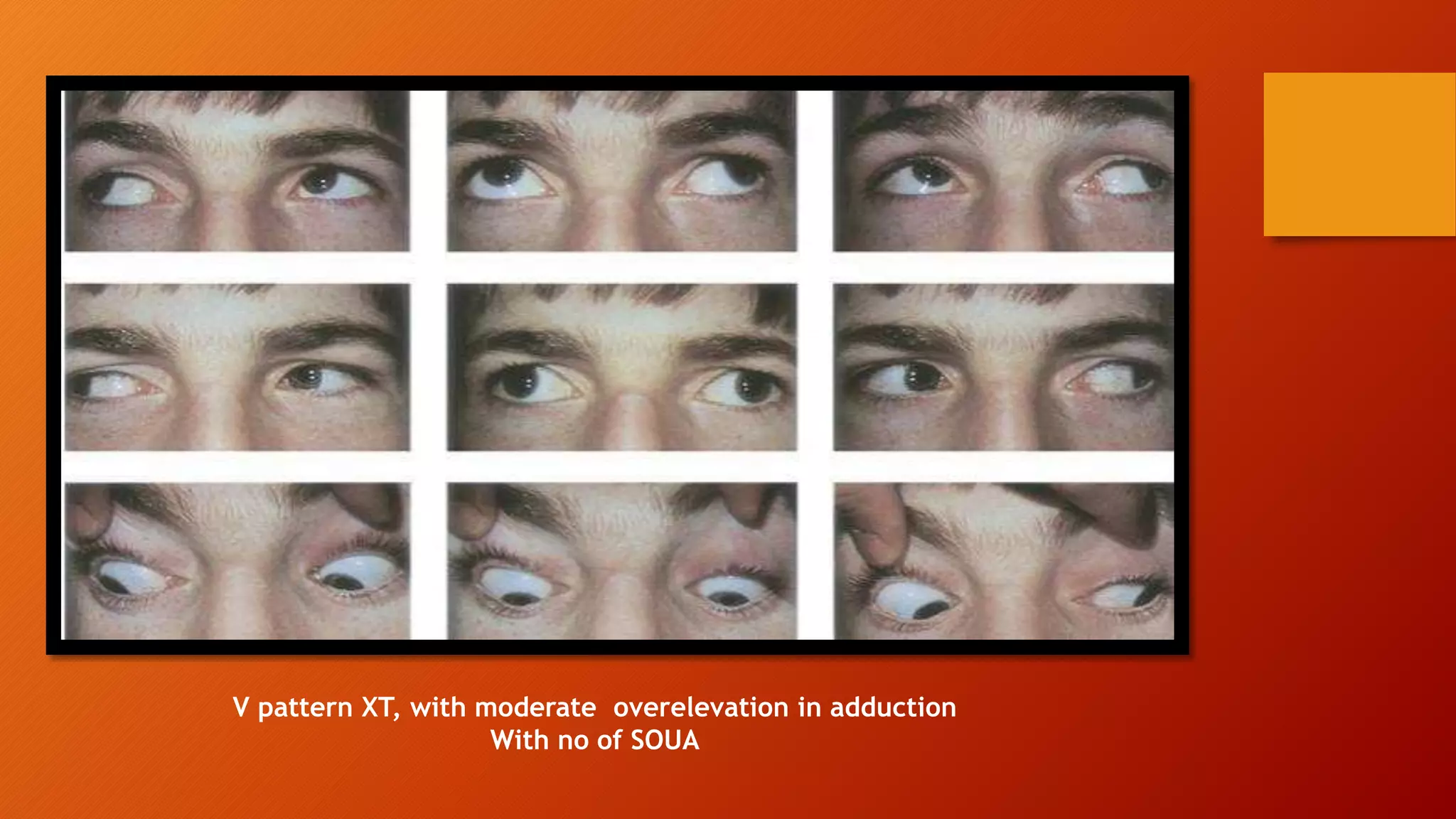 V pattern XT, with moderate overelevation in adduction
With no of SOUA
 