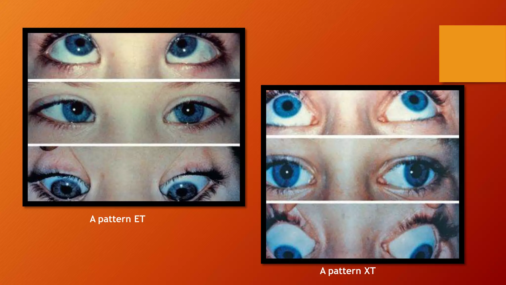 A pattern ET
A pattern XT
 