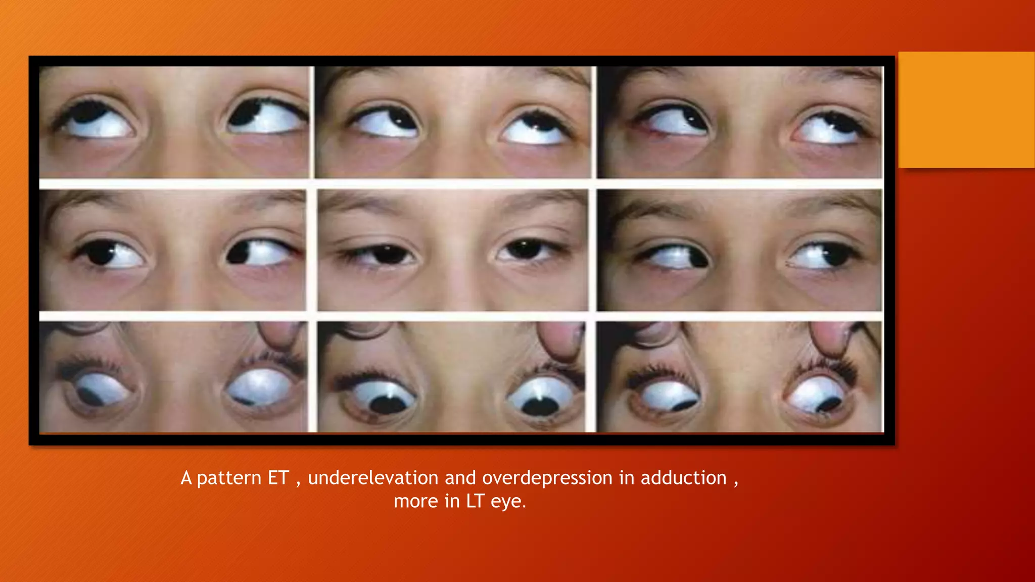 A pattern ET , underelevation and overdepression in adduction ,
more in LT eye.
 