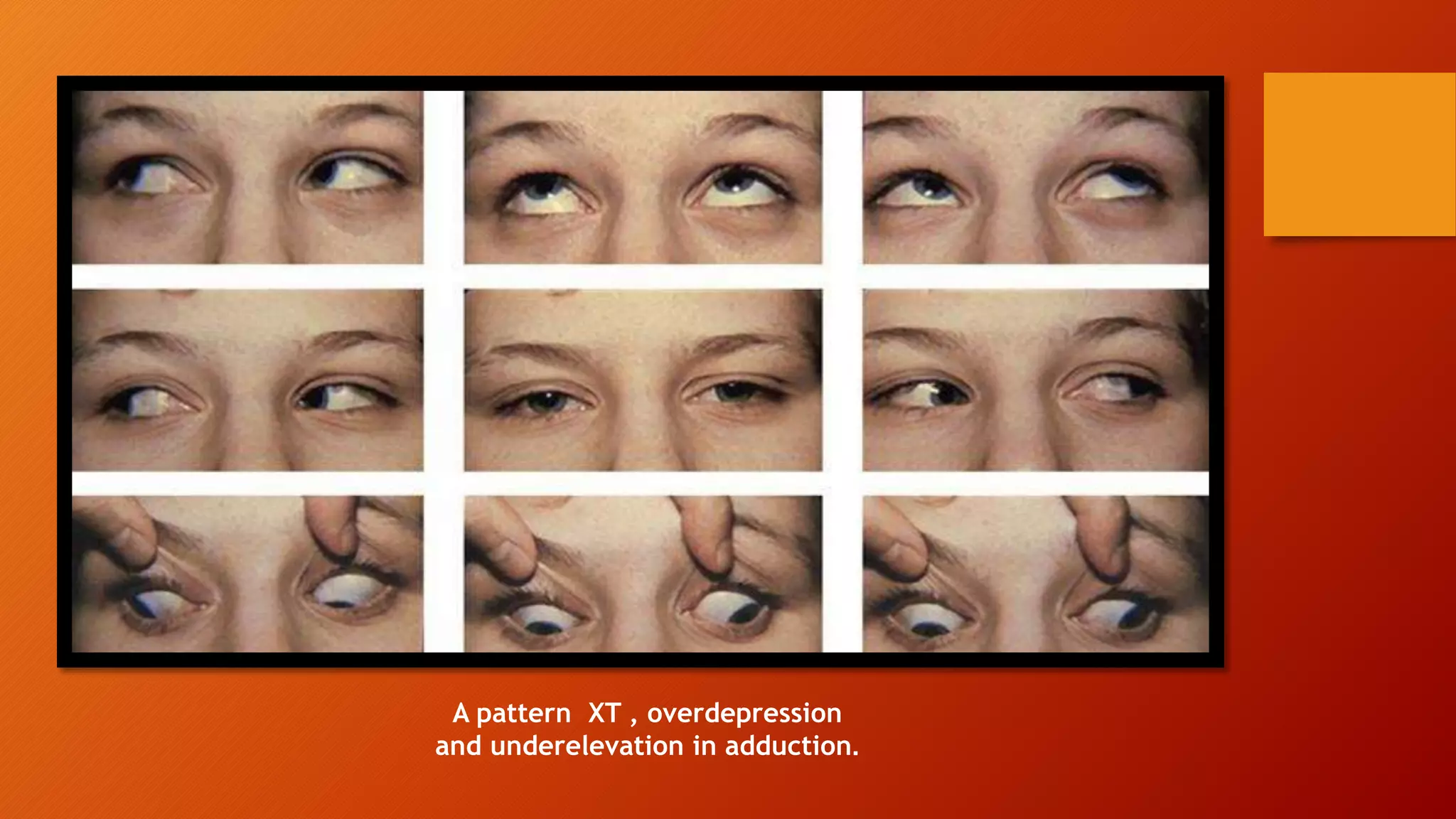 A pattern XT , overdepression
and underelevation in adduction.
 