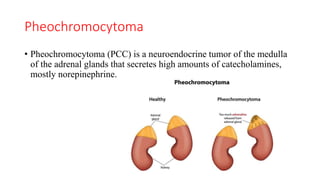 Pheochromocytoma
• Pheochromocytoma (PCC) is a neuroendocrine tumor of the medulla
of the adrenal glands that secretes high amounts of catecholamines,
mostly norepinephrine.
 