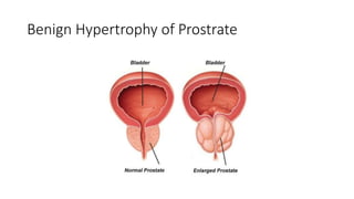 Benign Hypertrophy of Prostrate
 
