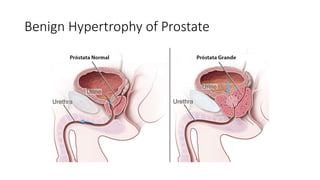 Benign Hypertrophy of Prostate
 