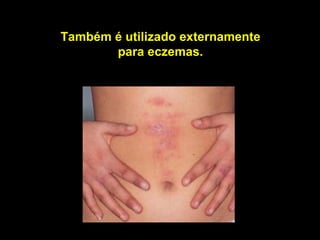 Também é utilizado externamente
       para eczemas.
 