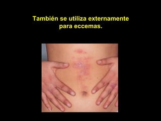 También se utiliza externamente
        para eccemas.
 