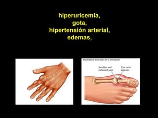hiperuricemia,
        gota,
hipertensión arterial,
      edemas,
 