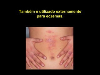 Também é utilizado externamente
       para eczemas.
 