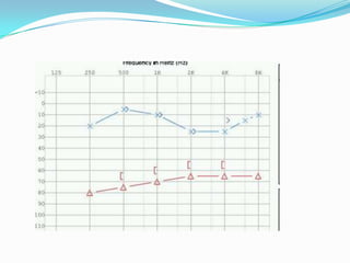 Slow progressive hearing loss