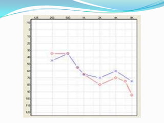 According to Rintleman(1976)3 types of audiogram          -trough shaped         -slop and flat shapedBilateral symmetrical hearing loss