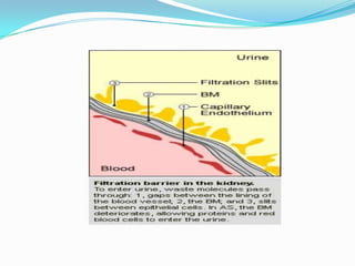    CHARACTERISTIC FEATURESChronic nephritis