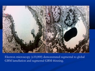 Electron microscopy (x10,000) demonstrated segmental to global
GBM lamellation and segmental GBM thinning.
 