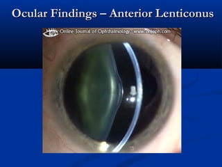 Ocular Findings – Anterior LenticonusOcular Findings – Anterior Lenticonus
 