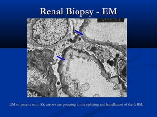 Renal Biopsy - EMRenal Biopsy - EM
EM of patient with AS, arrows are pointing to the splitting and lamellation of the GBM.EM of patient with AS, arrows are pointing to the splitting and lamellation of the GBM.
 