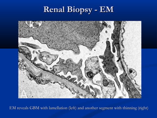 Renal Biopsy - EMRenal Biopsy - EM
EM reveals GBM with lamellation (left) and another segment with thinning (right)EM reveals GBM with lamellation (left) and another segment with thinning (right)
 