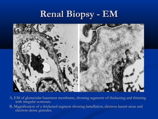 Renal Biopsy - EMRenal Biopsy - EM
A, EM of glomerular basement membrane, showing segments of thickening and thinningA, EM of glomerular basement membrane, showing segments of thickening and thinning
with irregular contours.with irregular contours.
B, Magnification of a thickened segment showing lamellation, electron-lucent areas andB, Magnification of a thickened segment showing lamellation, electron-lucent areas and
electron-dense granules.electron-dense granules.
 