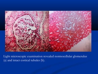 Light microscopic examination revealed normocellular glomerulus
(a) and intact cortical tubules (b).
 