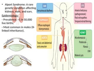 Alport Syndrome - a simple medical student view | PPTX