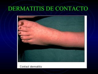 DERMATITIS DE CONTACTO 