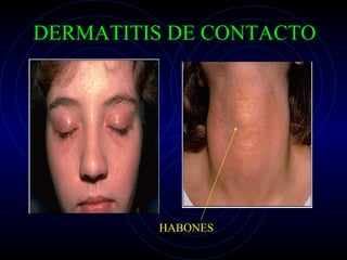 DERMATITIS DE CONTACTO HABONES 