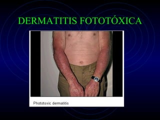 DERMATITIS FOTOTÓXICA 