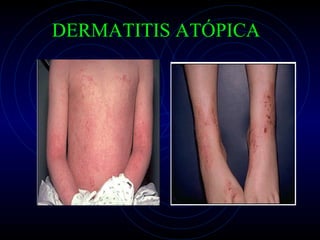 DERMATITIS ATÓPICA 