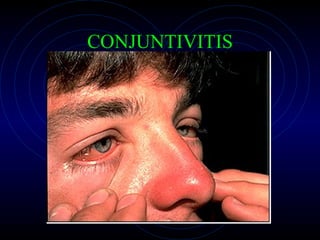 CONJUNTIVITIS 