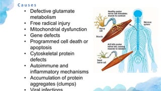 C a u s e s
• Defective glutamate
metabolism
• Free radical injury
• Mitochondrial dysfunction
• Gene defects
• Programmed cell death or
apoptosis
• Cytoskeletal protein
defects
• Autoimmune and
inflammatory mechanisms
• Accumulation of protein
aggregates (clumps)
 