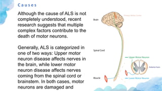 C a u s e s
Although the cause of ALS is not
completely understood, recent
research suggests that multiple
complex factors contribute to the
death of motor neurons.
Generally, ALS is categorized in
one of two ways: Upper motor
neuron disease affects nerves in
the brain, while lower motor
neuron disease affects nerves
coming from the spinal cord or
brainstem. In both cases, motor
neurons are damaged and
 