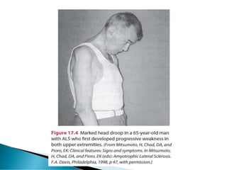 Amyotrophic lateral sclerosis (ALS) Motor neuron disorder | PDF