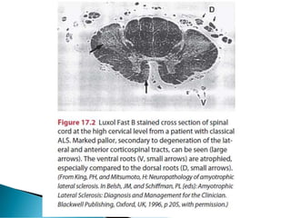 Amyotrophic lateral sclerosis (ALS) Motor neuron disorder | PDF