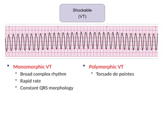 Shockable (VT)
Shockable
(VT)
• Polymorphic VT
• Torsade de pointes
• Monomorphic VT
• Broad complex rhythm
• Rapid rate
• Constant QRS morphology
 