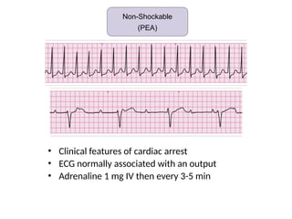• Clinical features of cardiac arrest
• ECG normally associated with an output
• Adrenaline 1 mg IV then every 3-5 min
Non-shockable (Asystole)
Non-Shockable
(PEA)
 