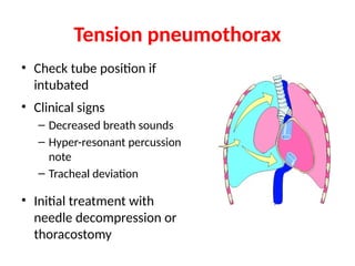 Tension pneumothorax
• Check tube position if
intubated
• Clinical signs
– Decreased breath sounds
– Hyper-resonant percussion
note
– Tracheal deviation
• Initial treatment with
needle decompression or
thoracostomy
 