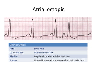 Als core ecg rhythm by dr vijaykumar silvaraja | PPT