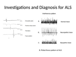 ALS_Detailed_Academic_Presentation .pptx