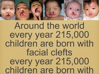 Around the world
every year 215,000
children are born with
facial clefts
every year 215,000
children are born with
 