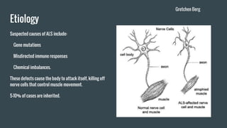 Etiology
Suspected causes of ALS include:
Gene mutations
Misdirected immune responses
Chemical imbalances.
These defects cause the body to attack itself, killing off
nerve cells that control muscle movement.
5-10% of cases are inherited.
Gretchen Berg
 
