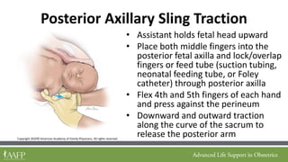 Obstetrics slide on shoulder dystocia and management | PDF