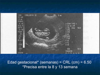 Edad gestacional* (semanas) = CRL (cm) = 6.50
*Precisa entre la 8 y 13 semana
 