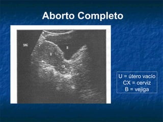 Aborto Completo
U = útero vacío
CX = cerviz
B = vejiga
 