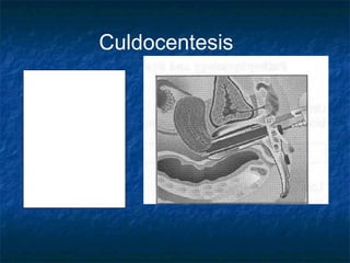 Aguja de 1.2 o 0.9 mm
de diámetro (18 or 20
gauge needle) pasada
a través del fondo del
saco vaginal posterior
y aspirada para
líquido
Líquido sanguíneo con
hematocrito > 15%
representa sangrado
intraperitoneal activo
Culdocentesis
 