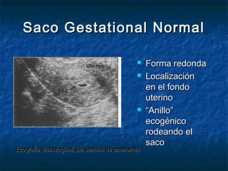 Saco Gestational NormalSaco Gestational Normal
 Forma redondaForma redonda
 LocalizaciónLocalización
en el fondoen el fondo
uterinouterino
 ““Anillo”Anillo”
ecogénicoecogénico
rodeando elrodeando el
sacosaco
Ecografía transvaginal, 5ta semana de amenorreaEcografía transvaginal, 5ta semana de amenorrea
 