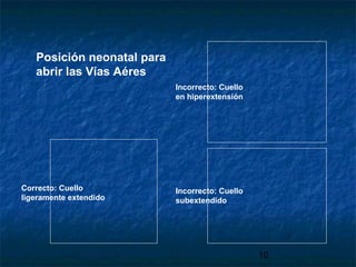 10
Posición neonatal para
abrir las Vías Aéres
Incorrecto: Cuello
en hiperextensión
Incorrecto: Cuello
subextendido
Correcto: Cuello
ligeramente extendido
 