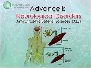 ALS Treatment in India | Stem Cell Treatment for ALS